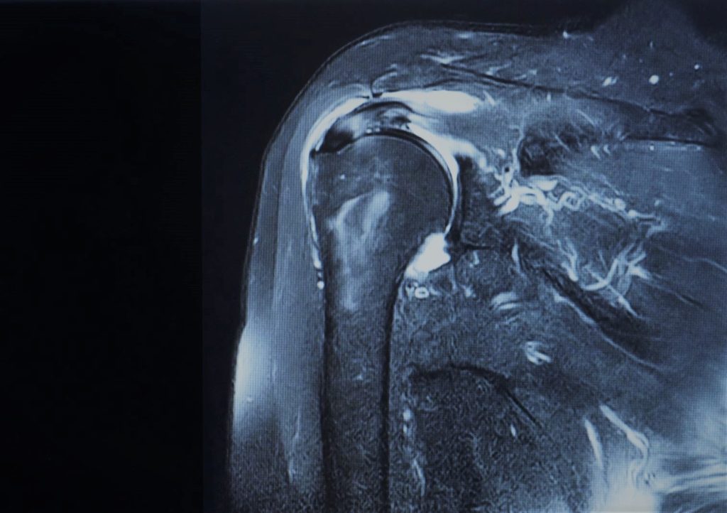 Safety of Above-the-Shoulder Work